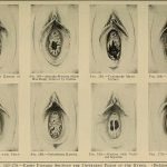 1280px-Gynecological_diagnosis_1910_14591495720