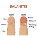Balanitis-Treatment