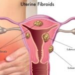 uterine-fibroids-2