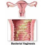 vaginosis