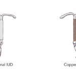 hormonal-and-copper-iud-illustration.gif__1200x1200_q65_subsampling-2